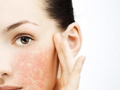 脸部皮肤换季过敏怎么办