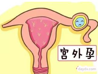宫外孕有哪些症状呢