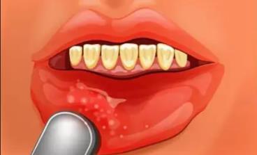 口腔溃疡怎么办最快最有效的方法西瓜霜