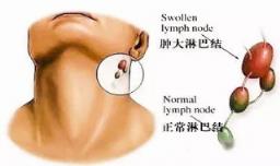 颈部淋巴结肿大怎么办 颈部淋巴结肿大的原因有四种