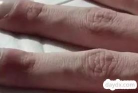 手指关节肿痛是什么原因引起的