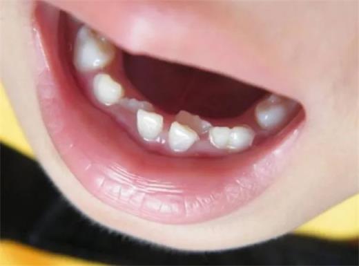 儿童换牙顺序是什么