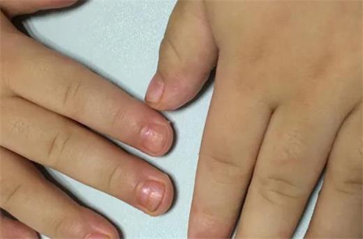宝宝指甲凹凸不平是为什么