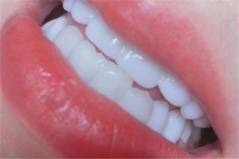 冰瓷美牙对牙有伤害吗